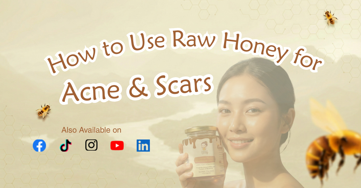 Raw honey for acne scars treatment